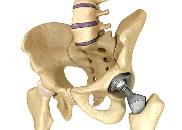 Endopróstética de la articulación de la cadera