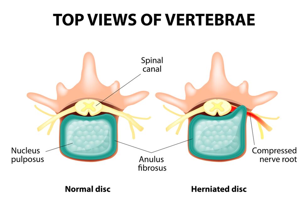 Disco intervertebral saludable y hernia