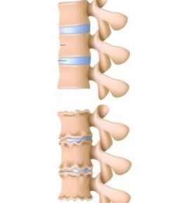 Las causas de la osteocondrosis