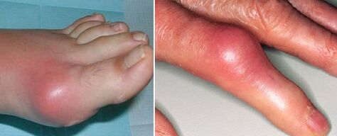 Aparición de articulaciones con artritis.