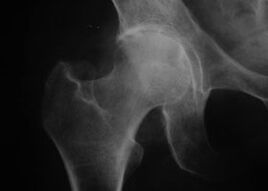 Radiografía de la articulación de la cadera con osteoartritis.