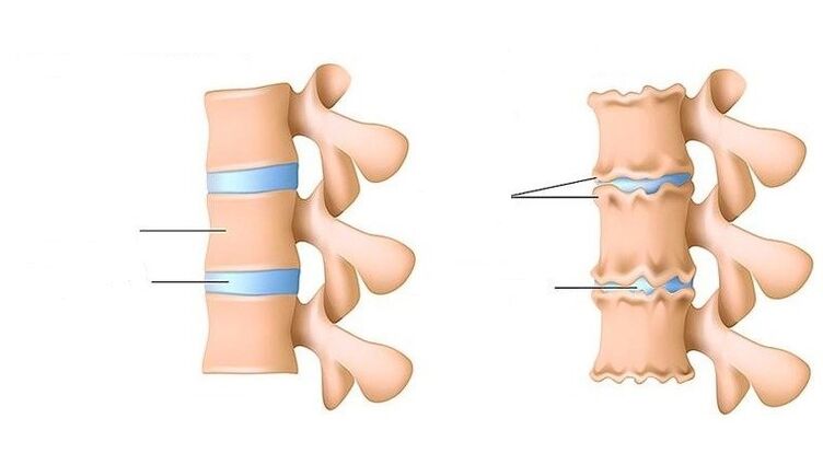 columna vertebral sana y columna afectada por osteocondrosis