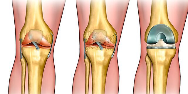 En la tercera etapa de la osteoartritis, se requiere un reemplazo de la articulación de la rodilla.