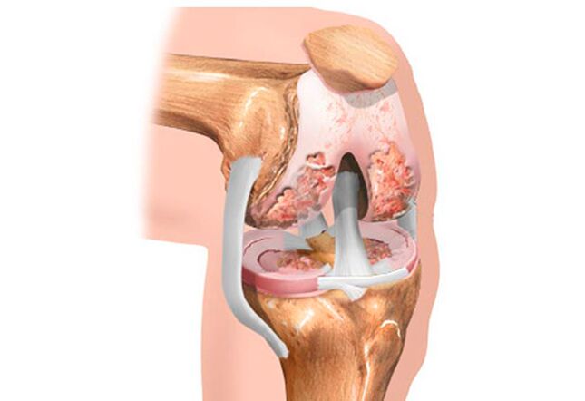 Osteoartritis de la articulación de la rodilla.