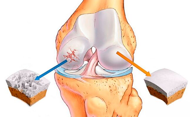 Una articulación de rodilla normal (derecha) y otra afectada por osteoartritis (izquierda)