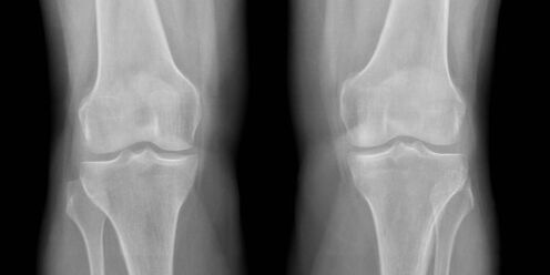 radiografía de la artrosis de rodilla