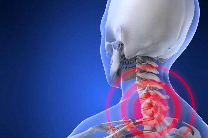 Dolor lancinante en el cuello un síntoma temprano de osteocondrosis cervical