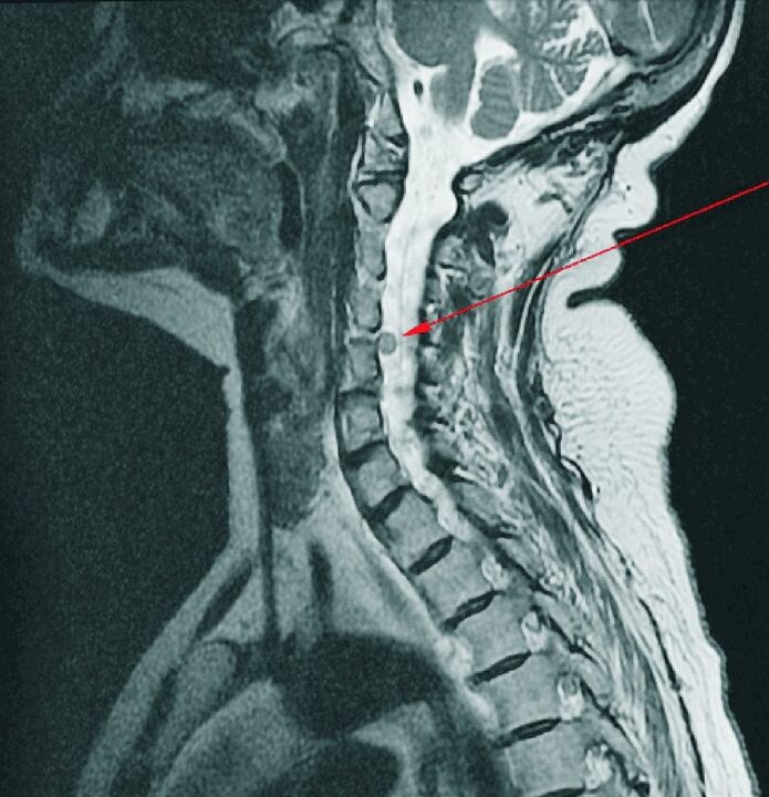 Hernia intervertebral de la columna cervical en resonancia magnética