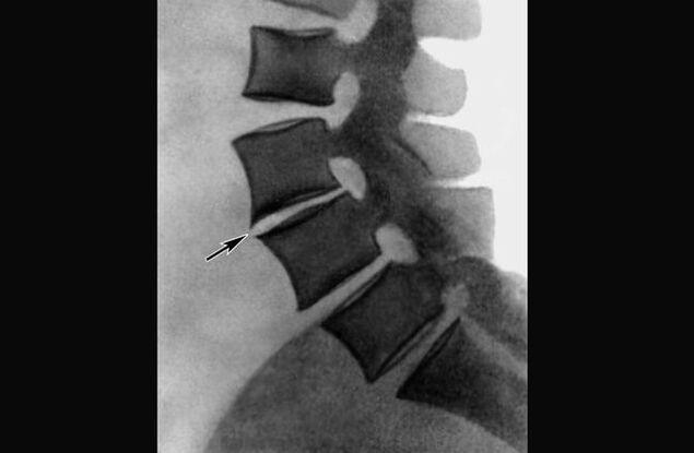 Manifestaciones de osteocondrosis de la columna torácica en la imagen de rayos X. 