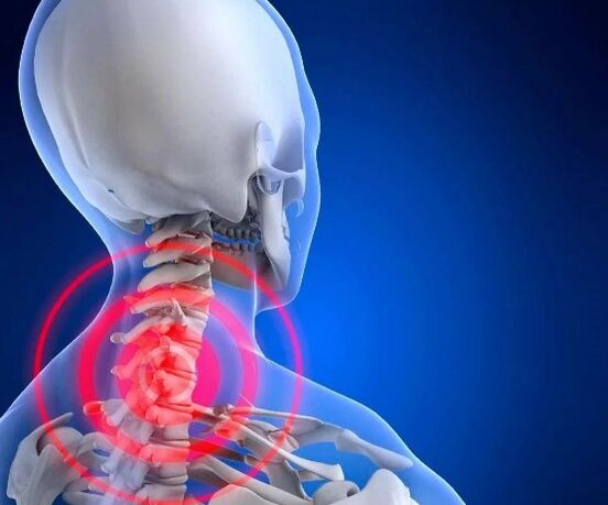 Osteocondrosis cervical